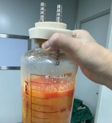 抚顺水动力吸脂手术要做多久？